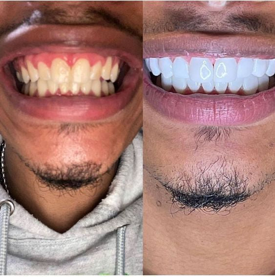 Sérum Correcteur de Couleur V34 Glorysmile – Dentifrice Violet Blanchissant & Menthe Fraîche